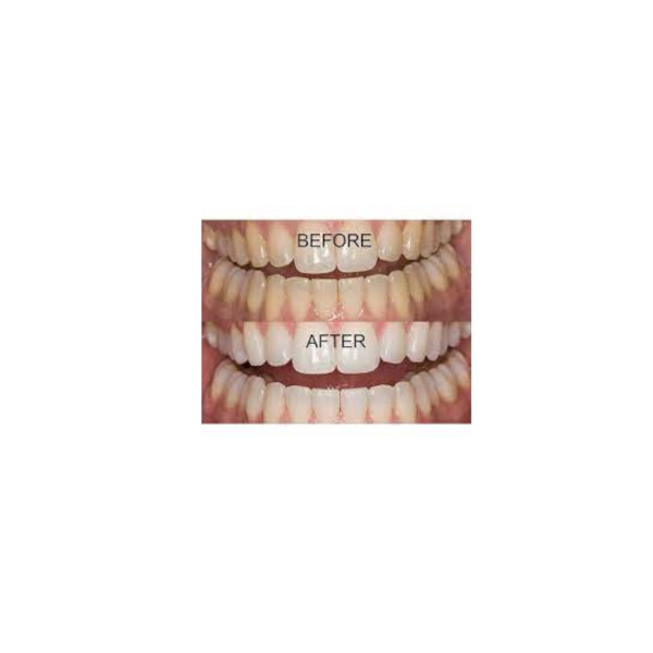 Opalescence PF 16% regular-2x2 šprice *samo za ordinacije*