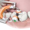 3 D FUSION Garrison Composi-Tight®3D Fusion™ FIRM set