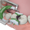 3 D FUSION Garrison Composi-Tight®3D Fusion™ FIRM set