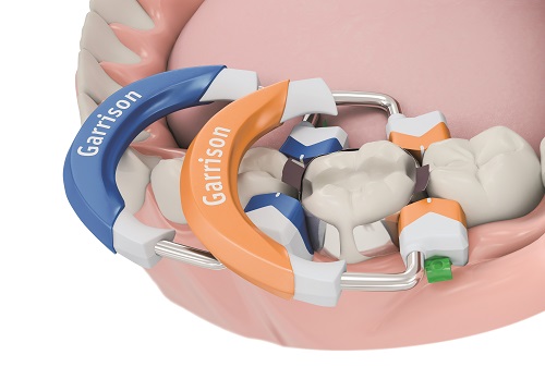 3 D FUSION FIRM SET Garrison Composi-Tight®3D Fusion™ FIRM set
