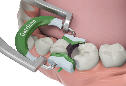3 D FUSION Garrison Composi-Tight®3D Fusion™ FIRM set